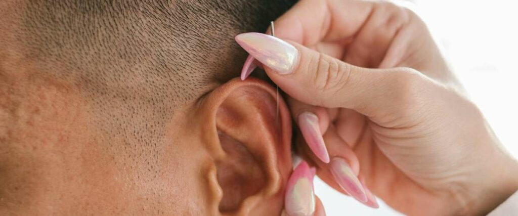 Acupuncture de l'oreille