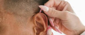 Acupuncture de l'oreille